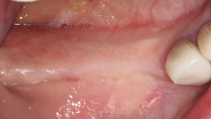 Post-op photograph of synthetic dental bone grafted alveolar ridge