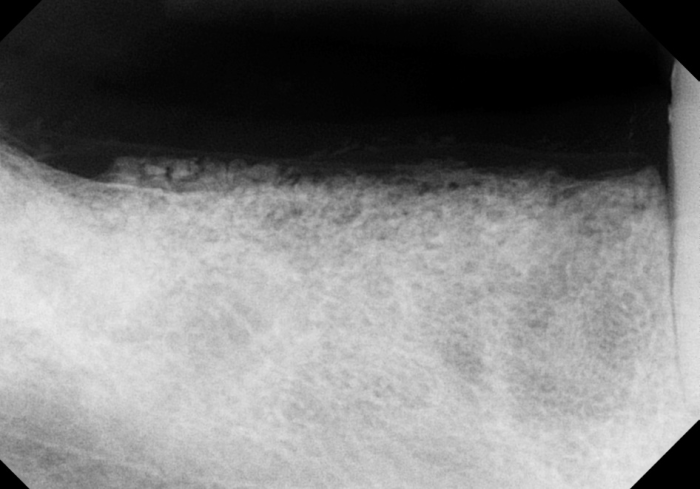 post-op radiograph of synthetic dental bone grafting site