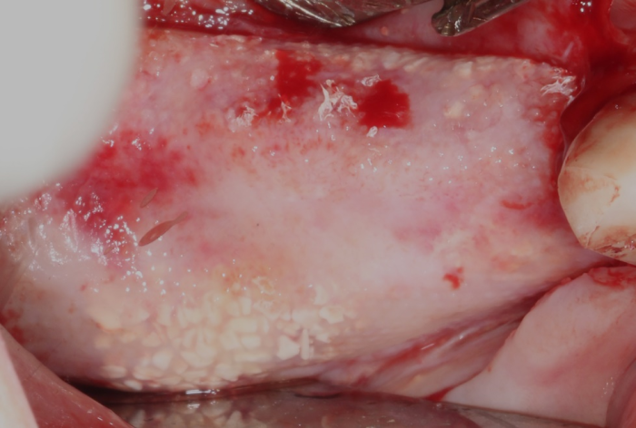ridge augmentation surgery showing membrane removal with granules visible on the lingual and buccal sides of the alveolar ridge