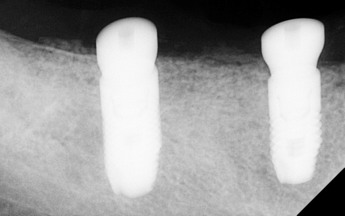 ridge augmentation surgery with 4.2 mm implant in the bicuspid area and a 4.8 mm implant in the molar area