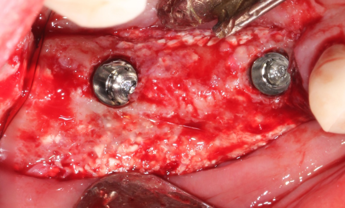 ridge augmentation surgery showing βTCP granules on lingual and buccal surfaces