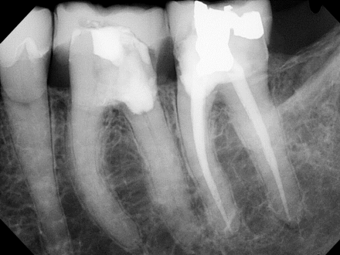 radiograph showing unrestorable first molar and long narrow roots