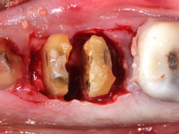complicated tooth extraction site
