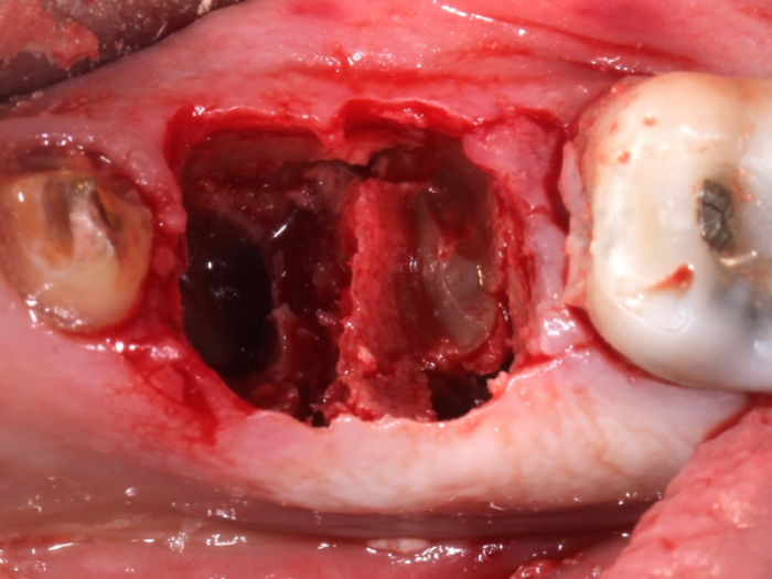 tooth extraction site with visible root tip