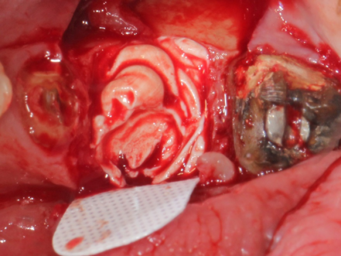 extraction site grafted with Socket Graft Injectable™