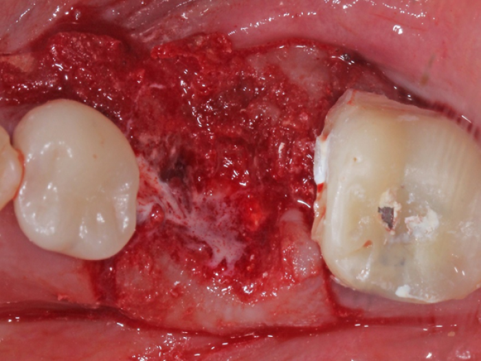 dental bone grafting site with membrane secured with Oral Bond™ and no sutures