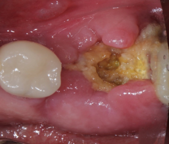 2 weeks post extraction with membrane secured with Oral Bond™ and no sutures