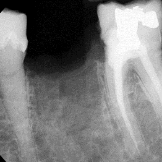 radiograph 4 weeks post extraction showing mineralization