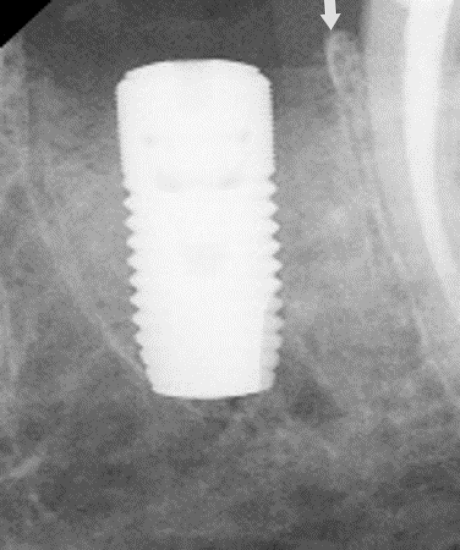 radiograph of early implant placement 4 weeks after extraction