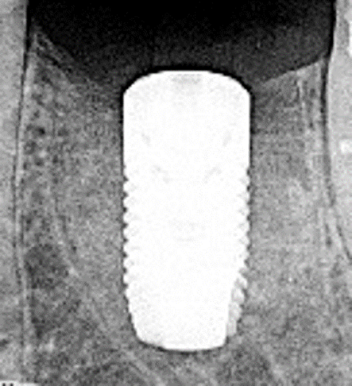 radiograph of dental implant 4 weeks after early implant placement showing mineralization