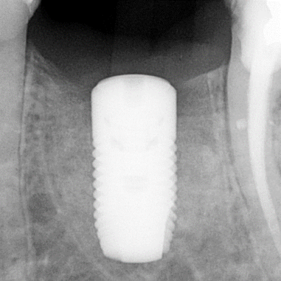 radiograph of dental implant 8 weeks after early implant placement