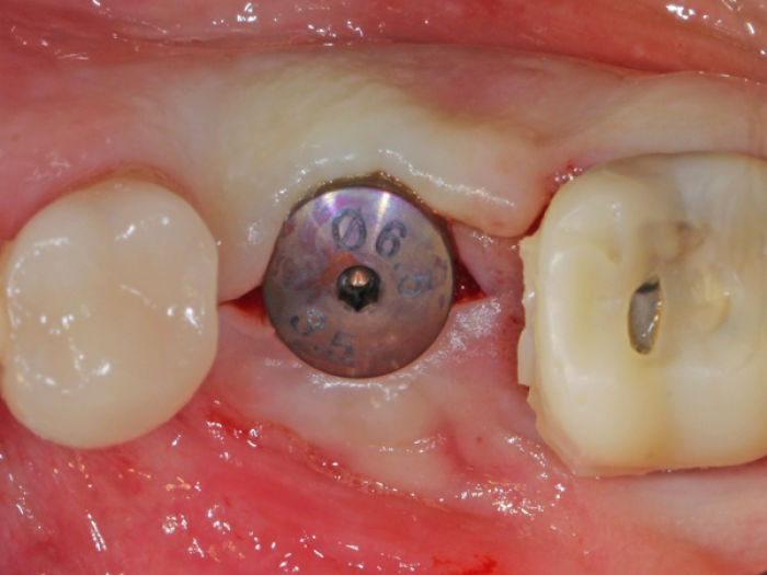 healing abutment after early implant placement showing retention of gingival tissue