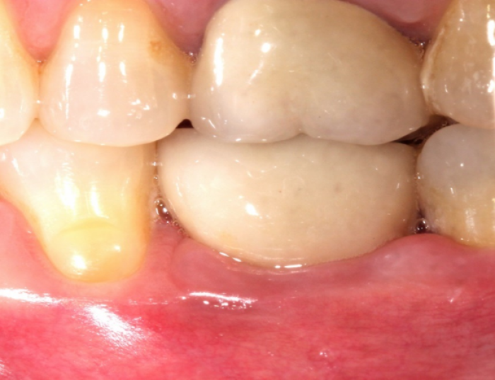 2 months after abutment, 8 days after cementation, patient presents with swelling and inflammation of the buccal gingiva