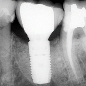 radiograph showing approximately 2mm of bone loss on the mesial of the implant