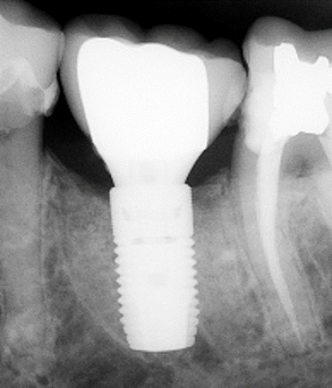 radiograph showing approximately 2mm of bone loss on the mesial of the implant