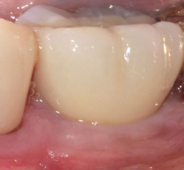 Four months after cement removal showing healthy gingiva
