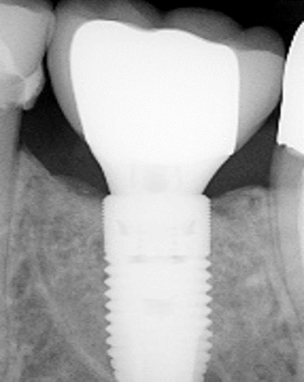 radiograph showing regeneration of the mesial marginal bone loss after cement removal