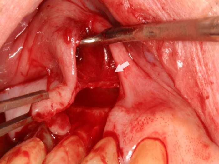 tissue pickups holding the gingiva, a spoon was used to dissect periosteum from mucosa