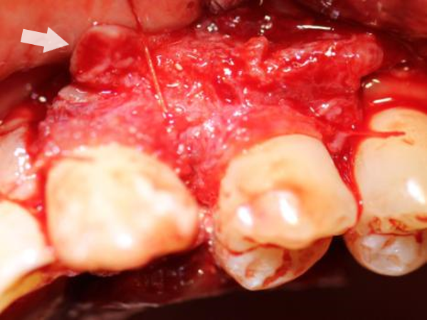 inverted periosteal graft surgery showing the periosteum being sutured around the teeth