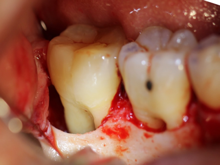 pre-op photograph of inverted periosteal graft surgery showing severe periodontal lesions