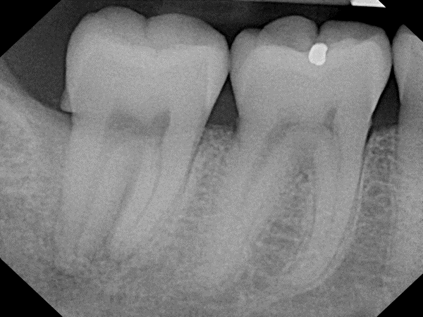 2-month post-op radiograph of inverted periosteal graft surgery