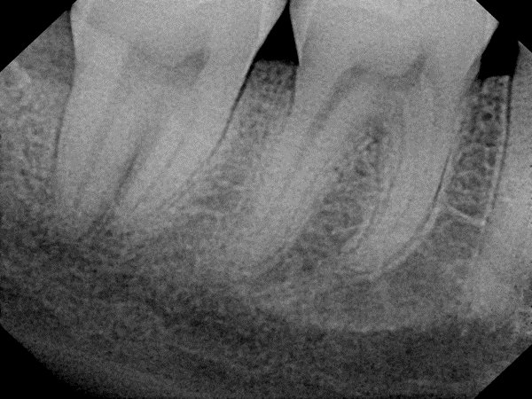post-op radiograph of inverted periosteal graft surgery