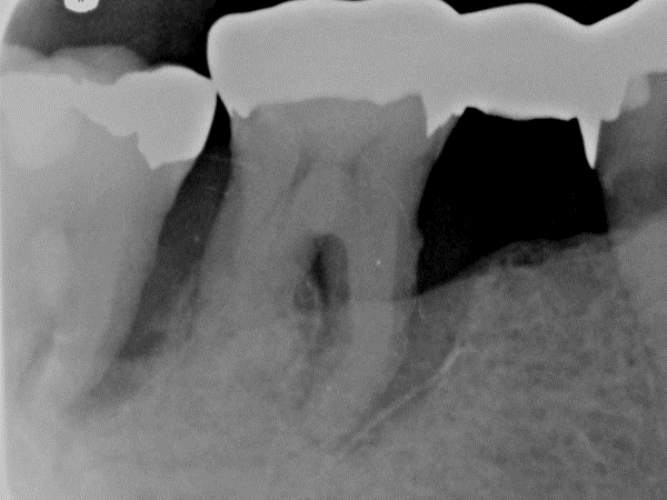 severe lesions to apex of involved teeth, distal molar was depressable with Class III mobility