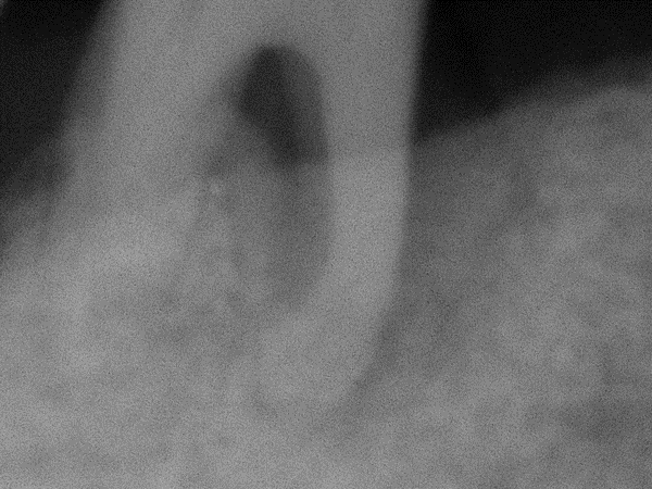 radiograph of distal molar presenting with 7mm lesion