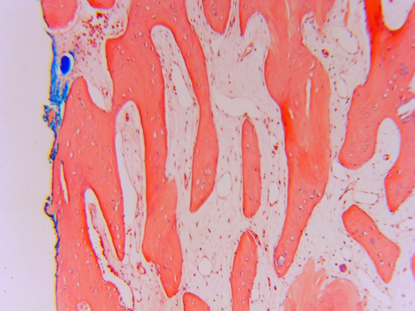 photomicrograph histology of cancellous bone in grafted site showing trabeculae, vascular supply, and no inflammation