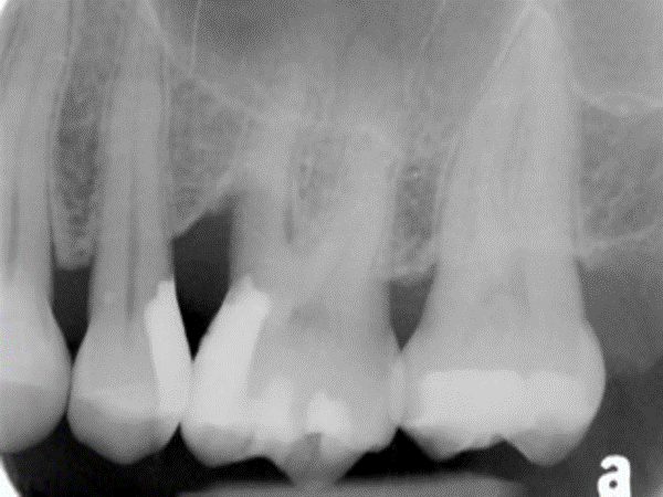 radiograph of first molar with mesial Class II furcation