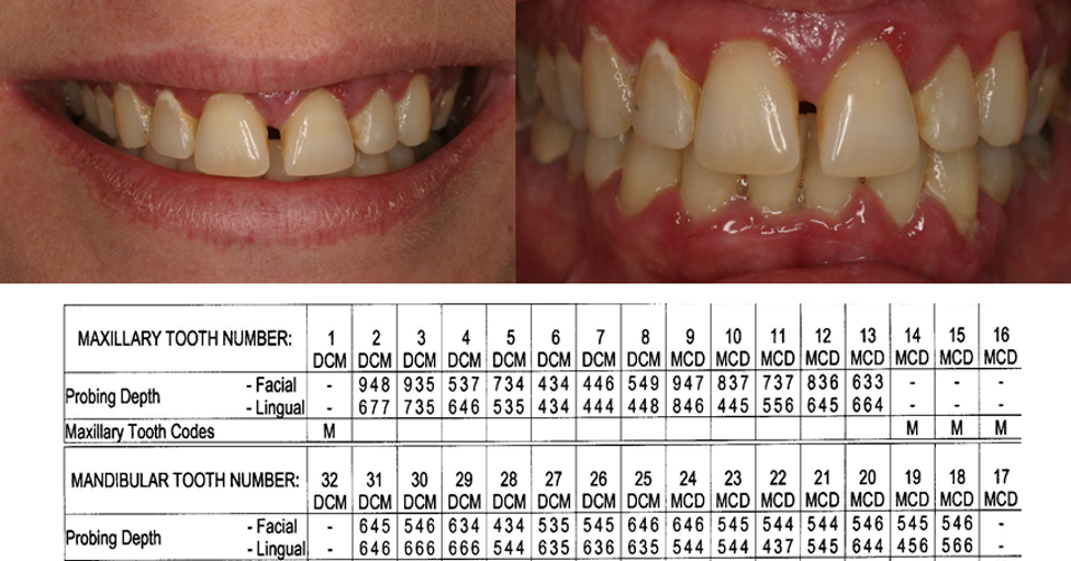 pre-op photos and periodontal probing numbers of inverted periosteal graft surgery