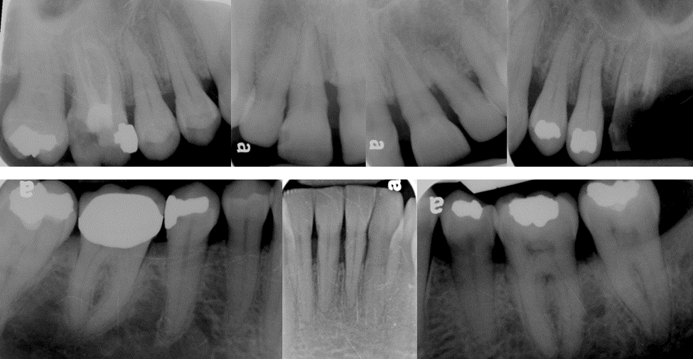 pre-op radiographs of inverted periosteal graft surgery