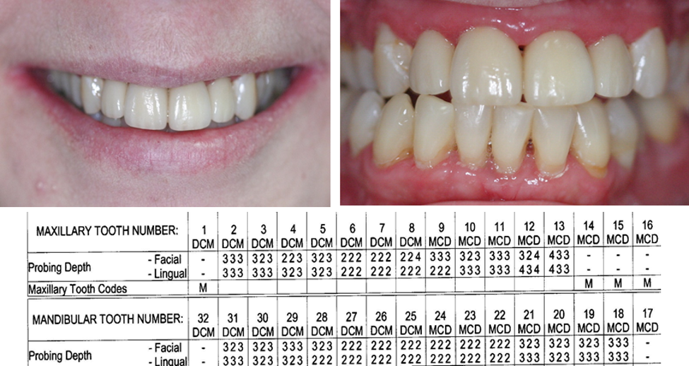 post-op photos and periodontal probing numbers of inverted periosteal graft surgery