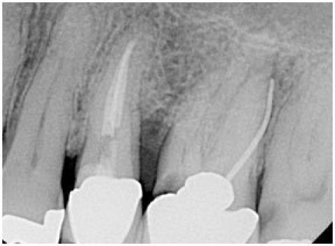 Sinus Graft