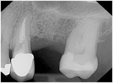 Sinus Graft