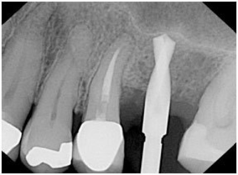 Sinus Graft
