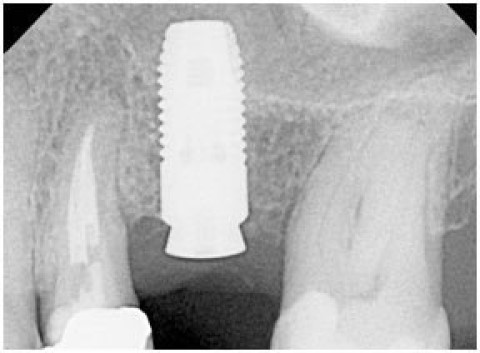 Sinus Graft