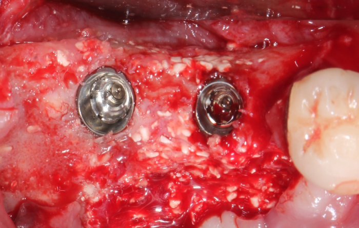 Ridge augmentation surgery, implants in place