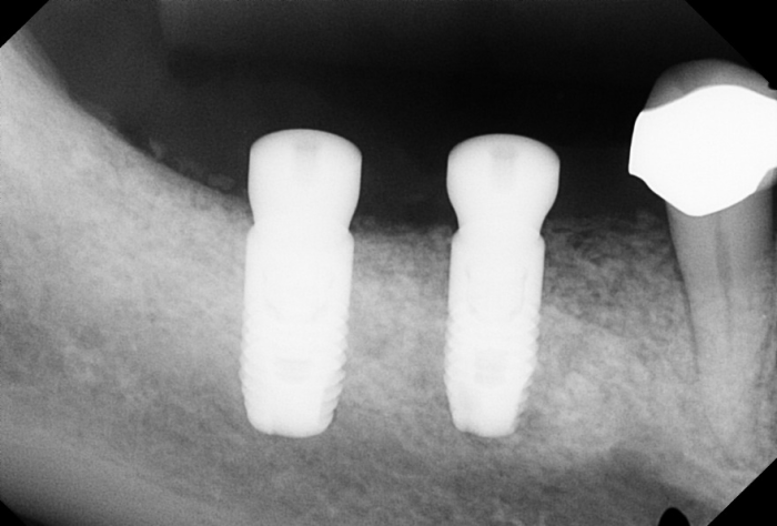 Radiograph of ridge augmentation surgery with implants and healing abutments