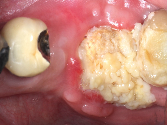 Oral surgery, membrane exposed