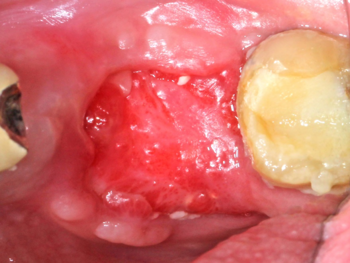 Oral surgery, membrane removed