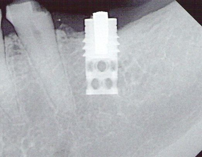 core vent implant