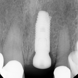 Predictable Immediate Implant Esthetics