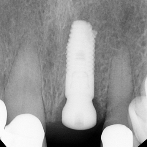Predictable Immediate Implant Esthetics
