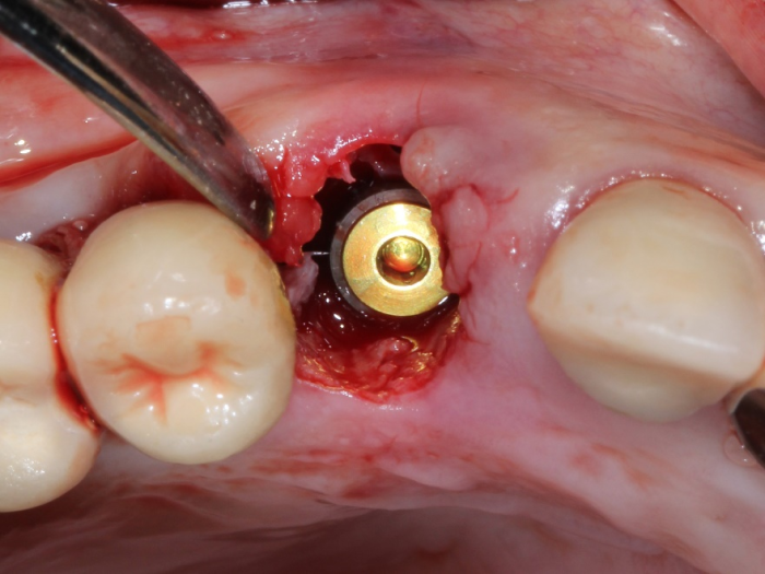 Predictable Immediate Implant Esthetics