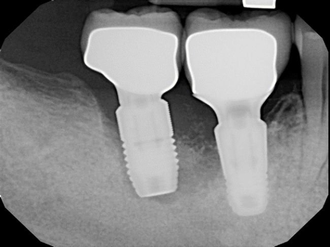 Implants placed in sites augmented with Bio-Oss and allograft.