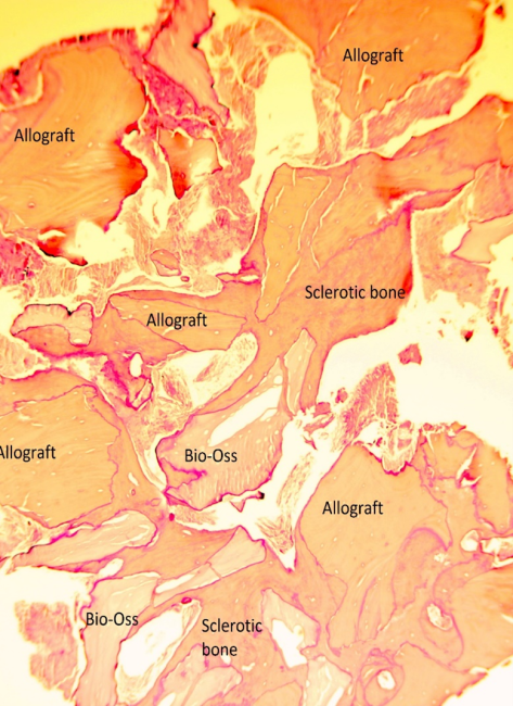 histology of the failed allograft Bio-Oss, sclerotic bone