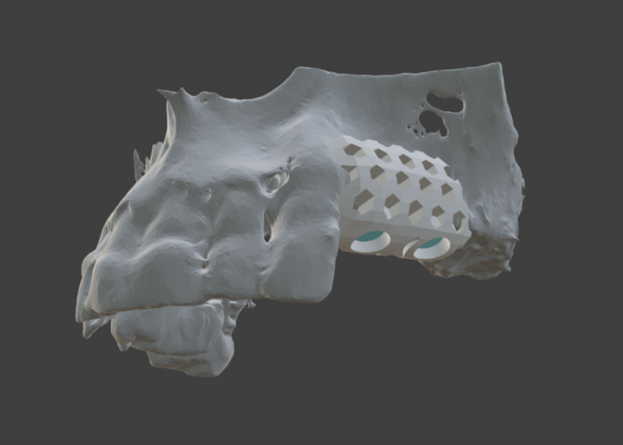 3D render of dental bone graft design