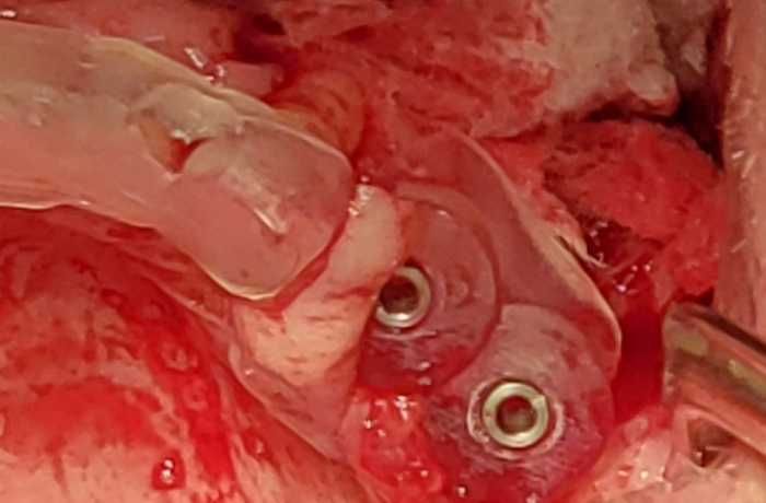Surgical stent to align the implants with the graft