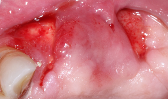 Membrane removal at 4 weeks. At this point, the membrane was still firmly bound to the underlying osteoid.